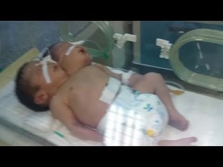 سيدة تلد طفلا برأسين وقلبين في أسوان