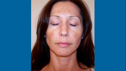bd-como-tratar-el-melasma-o-manchas-en-la-cara-301221