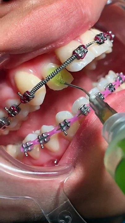 How to Wear Brace Dental Brace Toothtime Family Dentistry New 2022(1080P_HD)