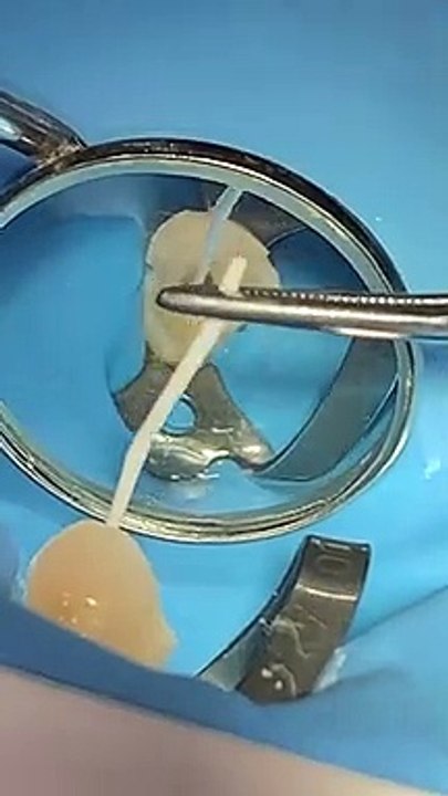 How to Wear Brace Dental Brace Toothtime Family Dentistry New 2022(720P_HD)_2