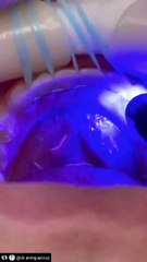 Author--_dr.enriquecruz_ _зубы__emax__dental__waxup__ivocap__dentist__ацетал__виниры__карвинг__дагестан__керамика__импланты__махачкала__стоматология__зубныете(video0)