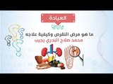 العيادة| ما هو مرض النقرص وكيفية علاجه؟ د/ محمد صلاح البدري يجيب