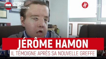 Jérôme Hamon - Il témoigne après sa deuxième greffe du visage