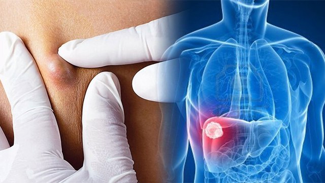 लिवर में गांठ का लक्षण | लिवर में गांठ का कारण | Liver Lump Symptoms In Hindi | Boldsky