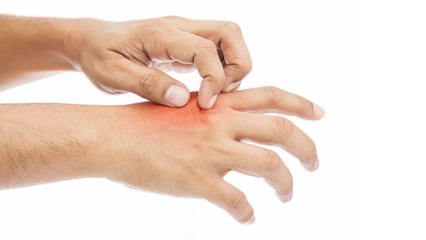 जलने पर क्या लगाना चाहिए, पानी डालना चाहिए या टूथपेस्ट लगाना | Boldsky