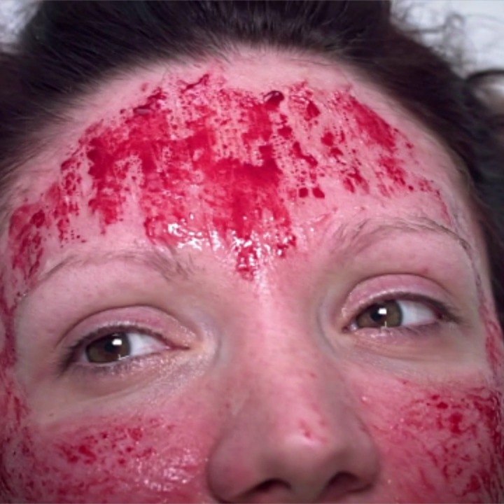 What to Know About Vampire Facials, the Treatment That Has Been Linked to Two Cases of HIV