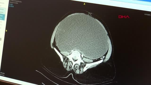 KARNINDAN 9 KİLOLUK TÜMÖR ÇIKTI