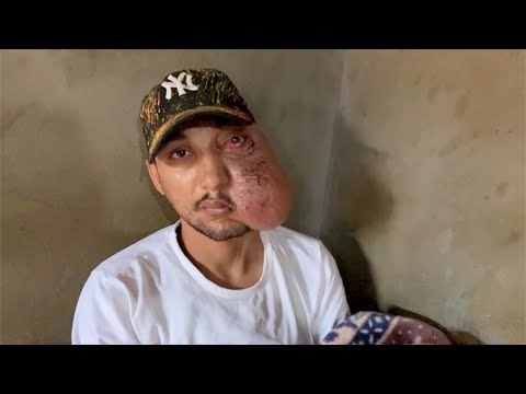 السيد يعاني من مرض نادر : بخاف أخرج من البيت بسبب تنمر الأطفال