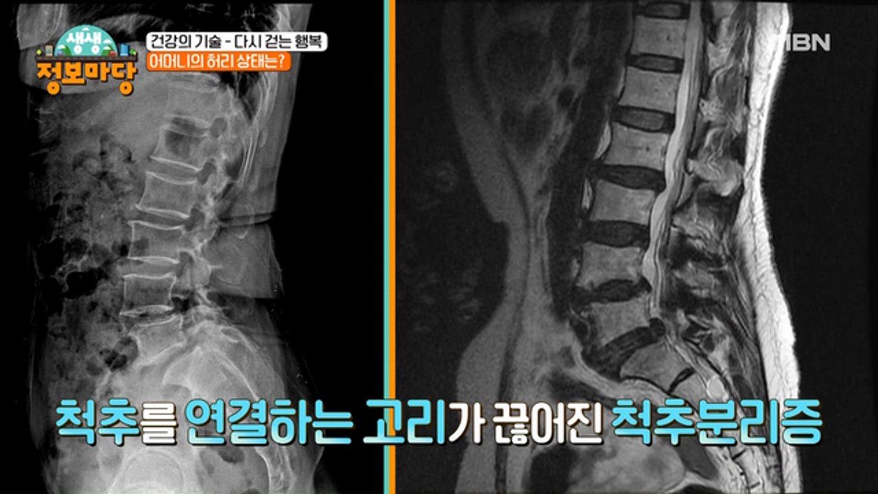 척추가 분리되는 척추 분리증!? 어머니의 허리는 괜찮을까..?