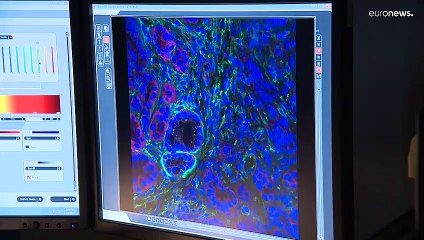 Una ricerca portoghese sulle cellule dei tumori al pancreas