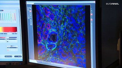 Cancer du pancréas : un nouvel espoir pour guérir la maladie