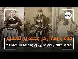 قصة حياتها وزواجها ستدهشك: «جوزفين» فتاة بأربعة أرجل وجهازين تناسليين