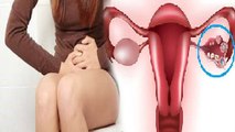 ओवेरियन सिस्ट का इलाज |  Ovarian Cyst का जबरदस्त आयुर्वेदिक इलाज | Boldsky