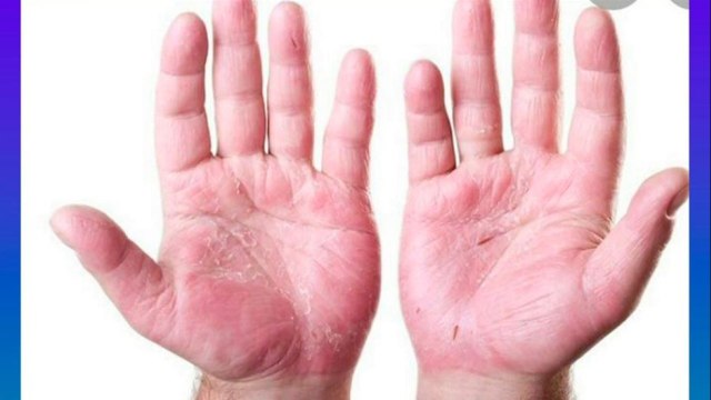 bd-hablamos-sobre-dermatitis-por-contacto-130122