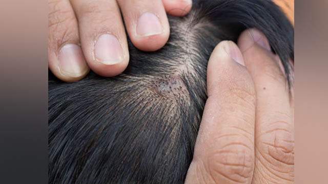 Scalp में Fungal Infection होने का Reason, Symptoms जानना जरूरी | Boldsky