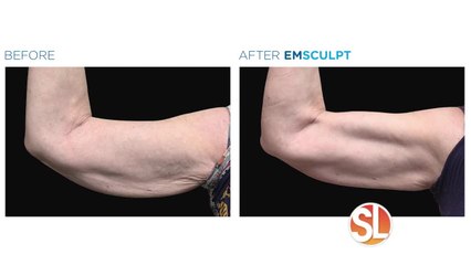 Contour Medical can help save those saggy arms