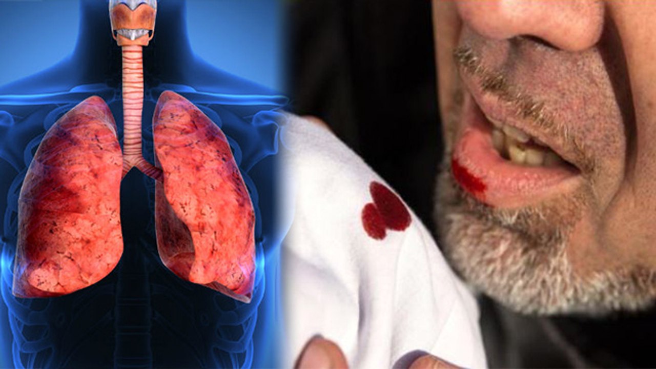 खांसी में खून आने का कारण Cough me Blood aane ka karan Boldsky