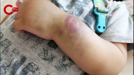 Hemofili hastası çocuklar, deri altına uygulanan ilacın SGK tarafından karşılanmasını bekliyor