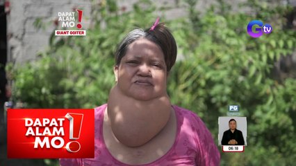 Dapat Alam Mo!: Napabayaang bukol sa leeg, lumaki na parang pakwan!