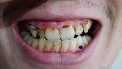 दांत में दिख रहे हैं भूरे व सफेद धब्बे है Fluorosis बीमारी, जानें लक्षण और इलाज । Boldsky
