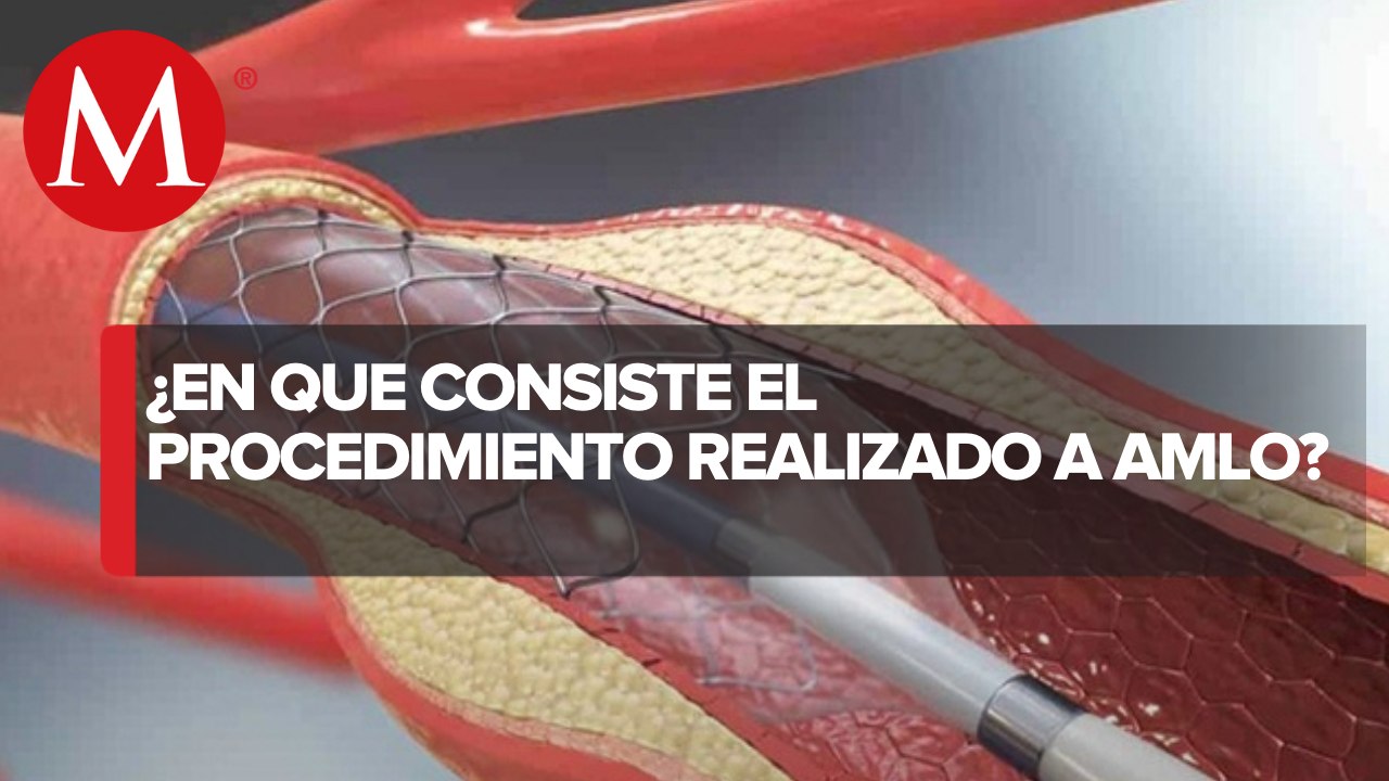 ¿Qué es el cateterismo cardiaco, el procedimiento que le realizaron a AMLO?