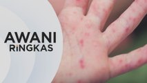 AWANI Ringkas: Kes HFMD turun | Tiada hubung kait