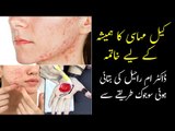 Keel Muhase Ka Gharelu Ilaj | Acne Treatment At Home | Sujok Therapy For Acne | Dr Umme Raheel Tips