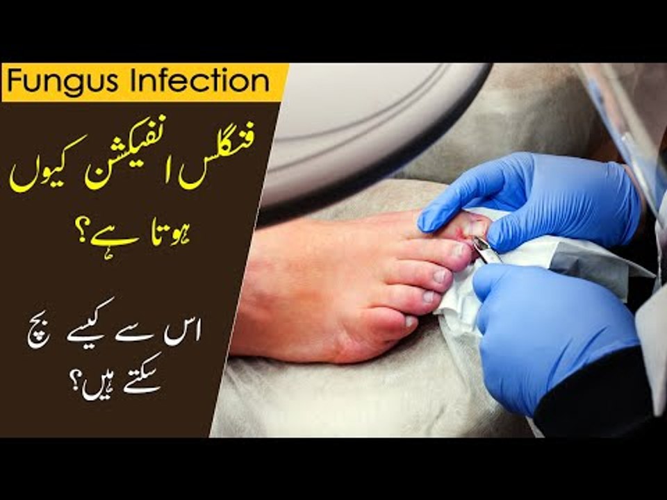 Fungal Infection Treatment Fungal Infection ka Ilaaj Tips by Dr