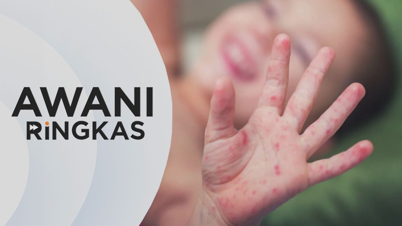 AWANI Ringkas: KKM jangka jangkitan HFMD menurun tiga minggu lagi