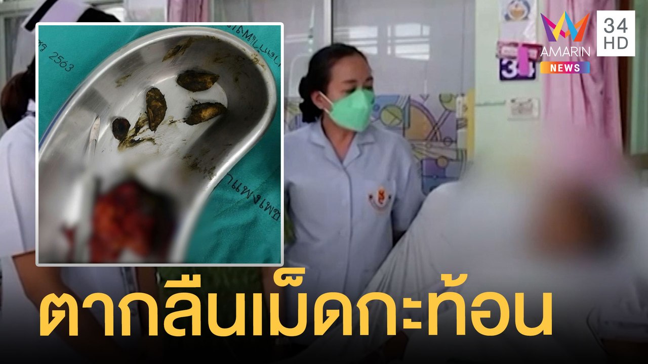 ตากลืนเม็ดกะท้อน หมอเตือนไม่ย่อยอันตรายถึงตาย | ข่าวเที่ยงอมรินทร์ | 9 มิ.ย.65