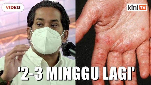 'HFMD akan mula turun dalam dua hingga tiga minggu lagi' - KKM