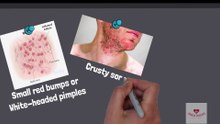 How to treat Folliculitis (red bumps or white-headed pimples) at home
