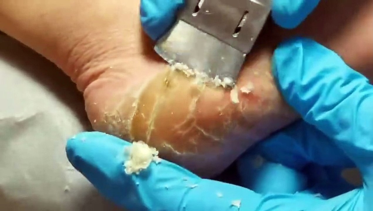 Wow! Look at cracked heels. Dead skin removal and Cracked heels treatment