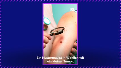 Woher kommen Muttermale und wieso heißen sie so?