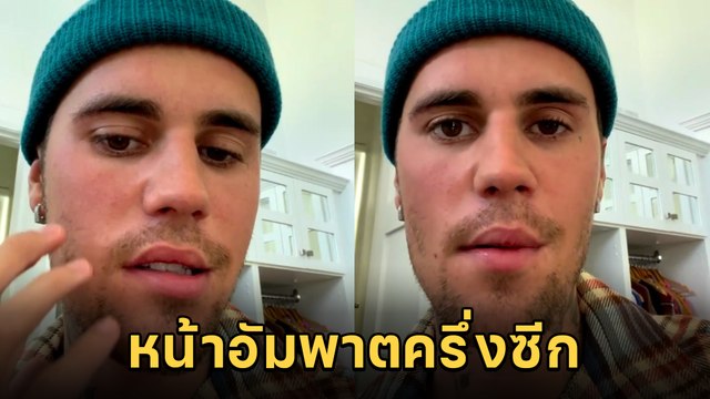 จัสติน บีเบอร์ เผยอาการป่วย หน้าอัมพาตครึ่งซีก ต้องเลื่อนทัวร์คอนเสิร์ต