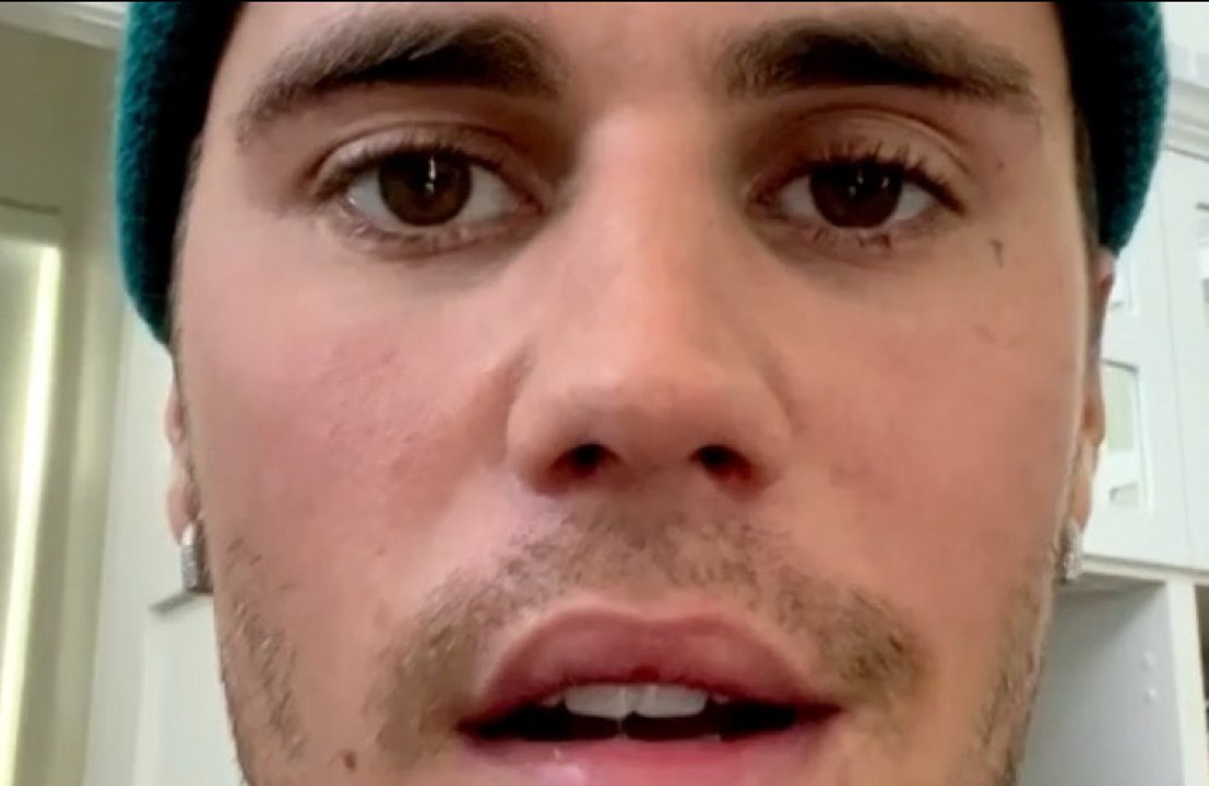 Justin Bieber leidet an Gesichtslähmung