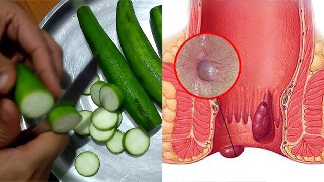 कड़वी तोरई लगाने से क्या होता है, Piles से लेकर Pregnancy रोकने में फायदेमंद कैसे | Boldsky *Health