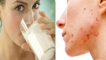 Dairy Product खाने से Pimples होते है क्या ? । Expert Advice । Boldsky । *Health