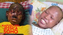 ANAK NG OFW NA NAGSUSUGAT AT NAGDURUGO ANG BALAT, KUMUSTA NA NGAYON?  | Kapuso Mo, Jessica Soho