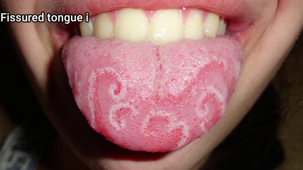 Fissured tongue