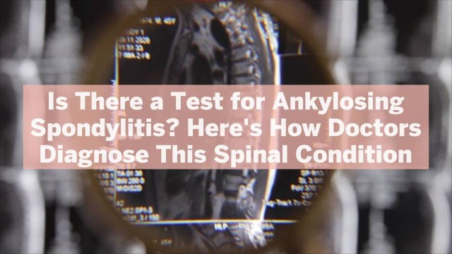 Is There a Test for Ankylosing Spondylitis? Here's How Doctors Diagnose This Spinal Condition