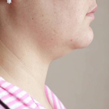 This Non-Invasive Treatment Can Give You a Permanently Sculpted Jawline in Just a Few Mont
