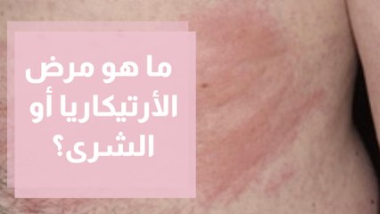 ما هو مرض الأرتيكاريا أو الشرى؟