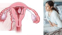 गर्भाशय पॉलीप क्या है, Symptoms नजरअंदाज करना खतरनाक | Uterine Polyp Kya Hai | Boldsky