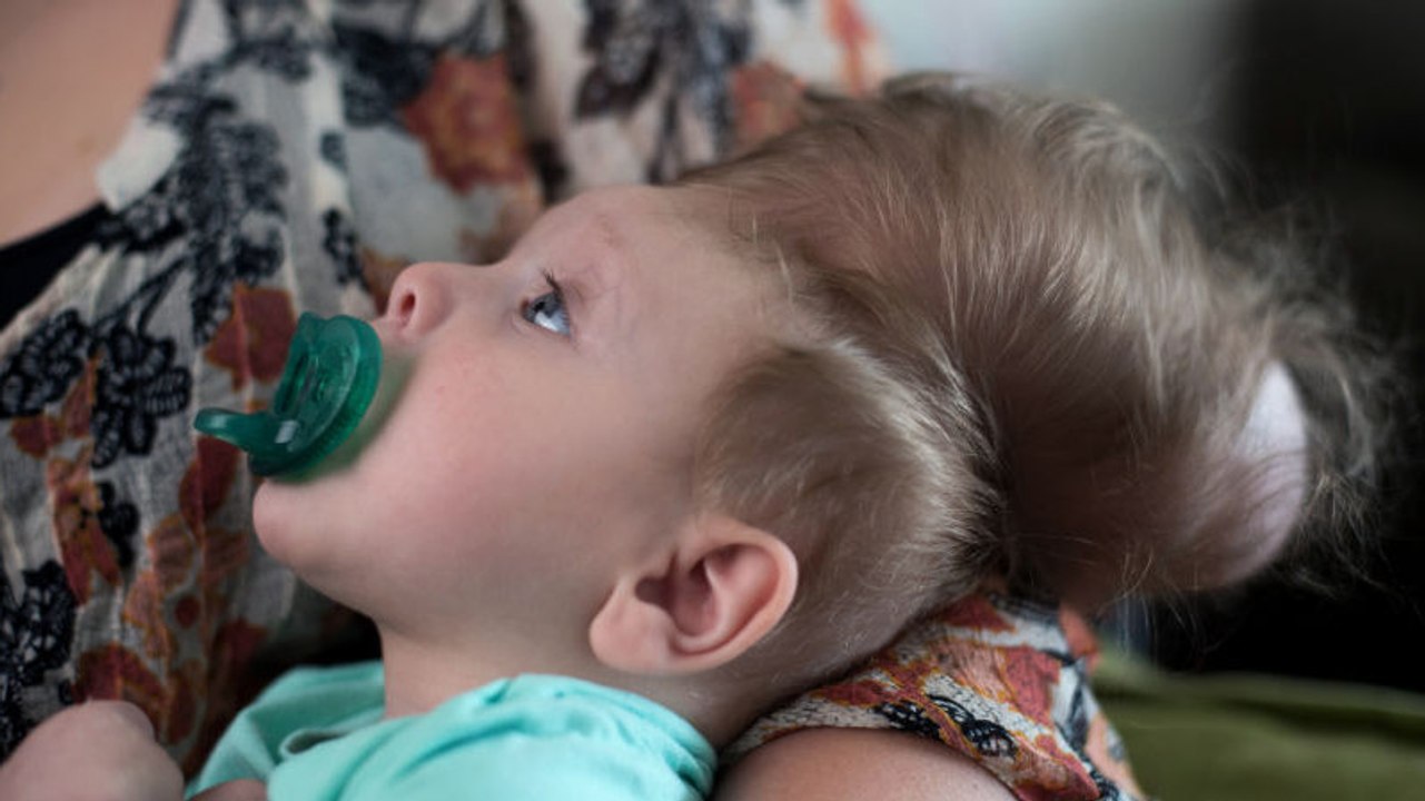 Un bébé miraculé vit avec son cerveau hors du crâne