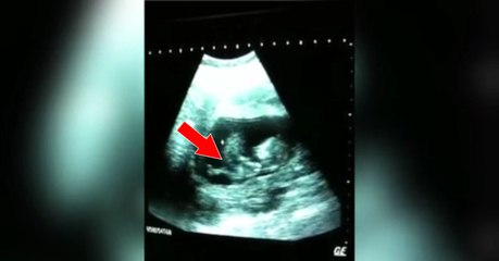 Ce bébé fait une chose incroyable à l'échographie... Les parents en restent sans voix !