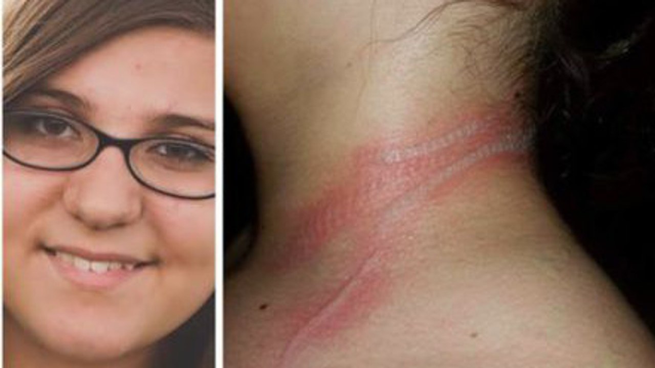 Une ado est brûlée au second degré à cause de son smartphone