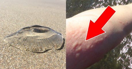 Que faire en cas de piqûre de méduse ?