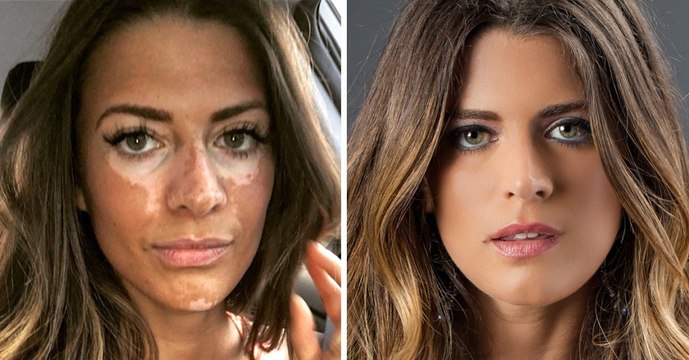 Breanne Rice : cet ancien mannequin s'est caché pendant 12 ans pour cacher sa maladie !