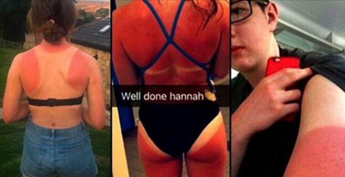 Voilà comment finissent les Anglais qui veulent bronzer au soleil !